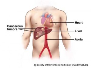 liver tumor picture